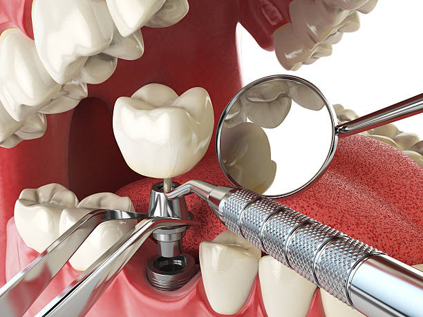 Best Emergency Denture Repair in New Miami, OH